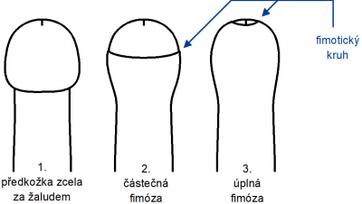 Narezanie predkozky u dospelých