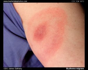 erythema migrans