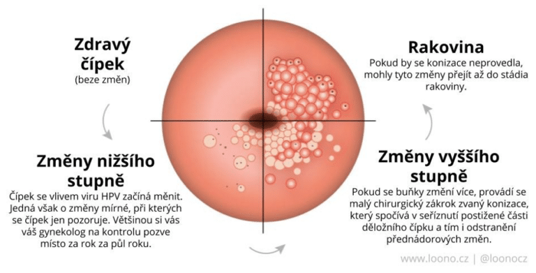HPV