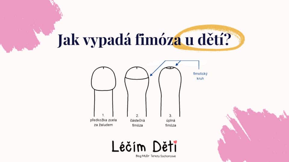 Fimoza u deti infografika